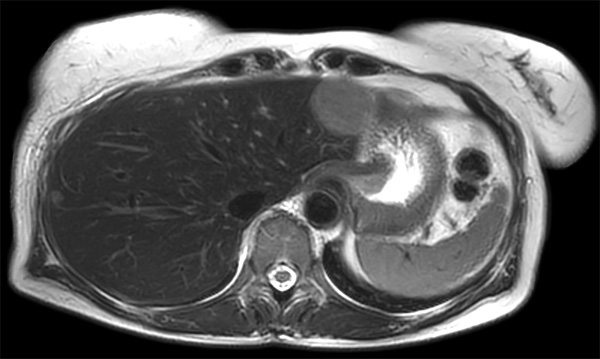 Axial T2w MultiVane XD